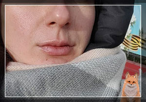 Моя контурная пластика губ в 36 лет