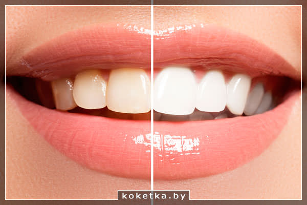 Как сделать зубы белее?
