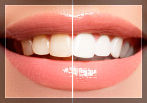 Как сделать зубы белее?