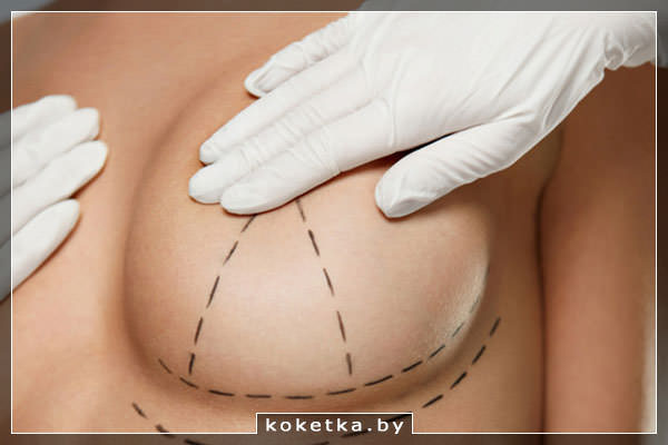 Пластический хирург намечает линии надрезов для коррекции груди