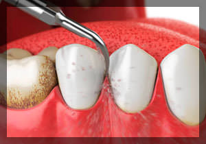 Зубной камень: что это и как от него избавиться