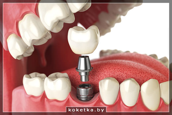 Протезирование зубов в Polimagia.by: восстановить потерянное