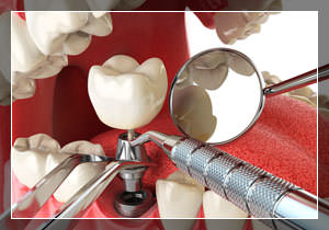 Преимущество имплантации зубов