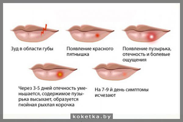 Стадии развития герпеса на губах