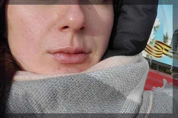 Контурная пластика губ в 36 лет