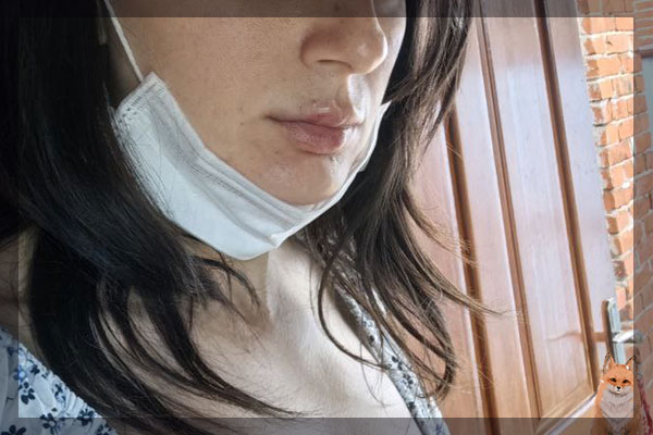 Сразу после введения 0,6 мл в губы филеров