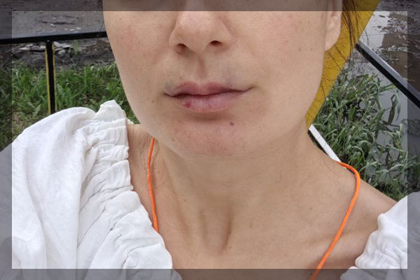 Через несколько дней после коррекции губ