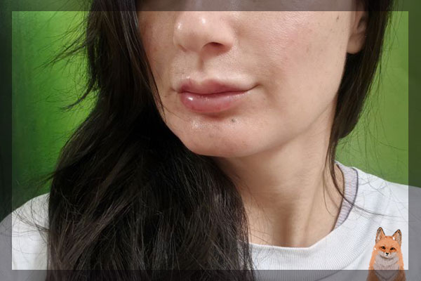 Ещё 0,5 мл гиалуронки филеров в губы