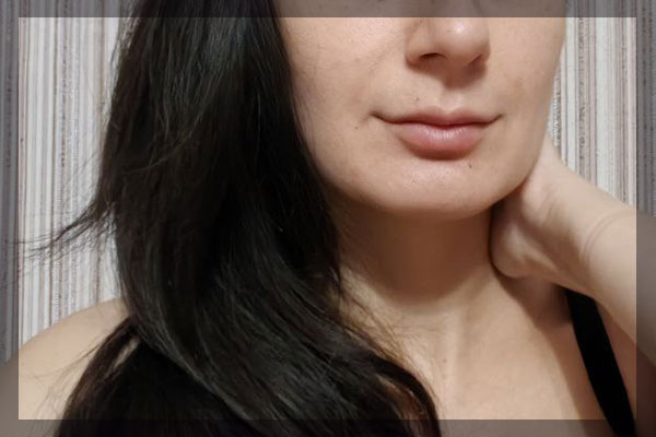 1,1 мл филеров в губах, отёк спал