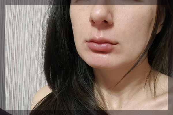 Вот такой рещультат - губы с филлерами и релатокс
