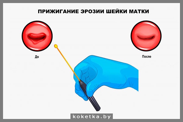 Прижигание эрозии: до и после на картинке